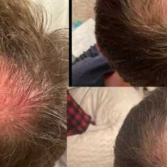 Hair Loss Clinic Havertown, PA · Tuesday, May 13 📸