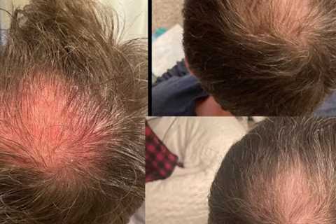 Hair Loss Clinic Havertown, PA · Tuesday, May 13 📸