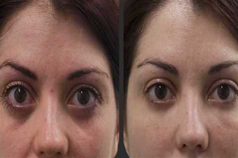 From Reiki to Radiance: Why More People Are Choosing Fillers in Zürich for a Refreshed Appearance